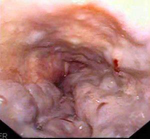 Variceal Bleeding